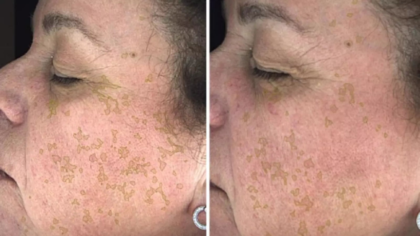 Serum Retinal Complex