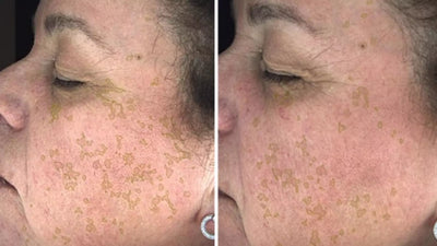 Serum Retinal Complex